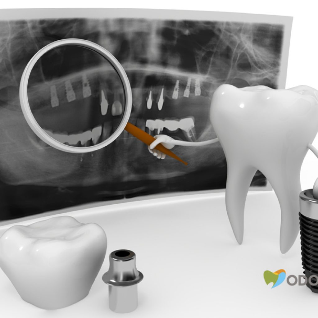como-funciona-o-implante-dentario