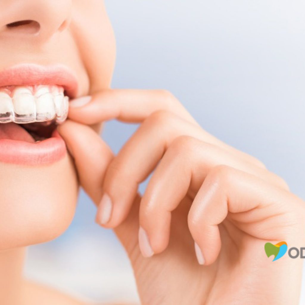 quanto-custa-o-invisalign