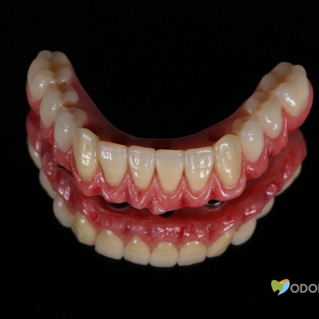 dentadura-fixa-em-implantes-clinica-odontomania