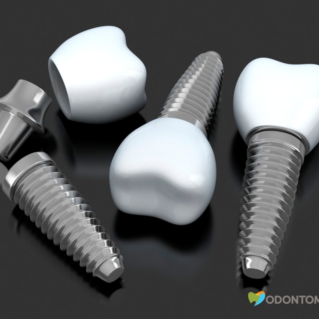 implante-dentário-clinica-odontomania
