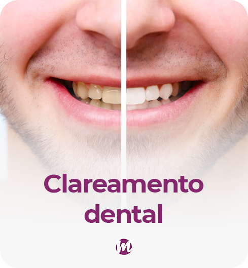 clareamento