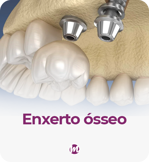 enxerto