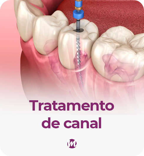 tratamento de canal