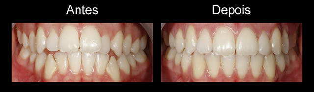 tratamento_ortodontico_antes_depois