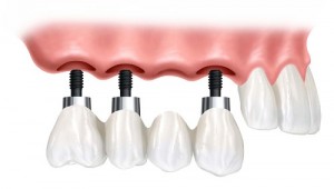 implantes-dentarios