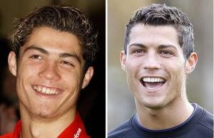 cristianoronaldo-teeth_before-after