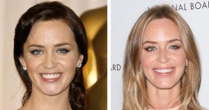 emily-blunt-before-after-dental-veneers1