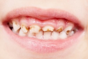 dentes-cariados-na-boca-de-uma-crianca-foto-nrtshutterstockcom-00000000000167F3