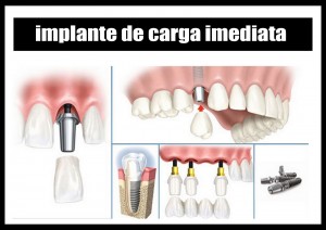 implante-imediata
