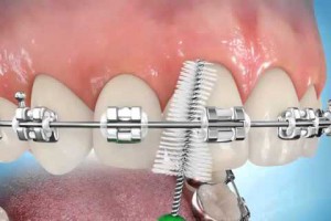 interdental