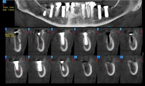 invasc3a3o-do-espac3a7o-do-canal-mandibular-001