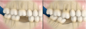 perda-de-dentes-e-suas-consequecias.