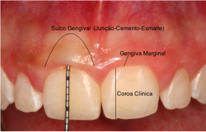 sorriso gengival erupção