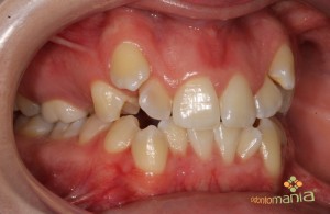 Intra Bucal Lateral Direita 2