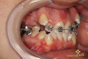 Intra Bucal Lateral Direita 3
