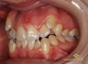 Intra Bucal Lateral Esquerda 2