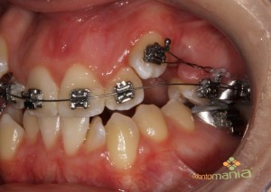Intra Bucal Lateral Esquerda 3