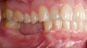 Perda-Dentária-Inferior-Extensa-300x166