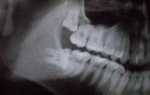 dentes-impac1