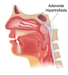 hipertrofia-das-adenoides