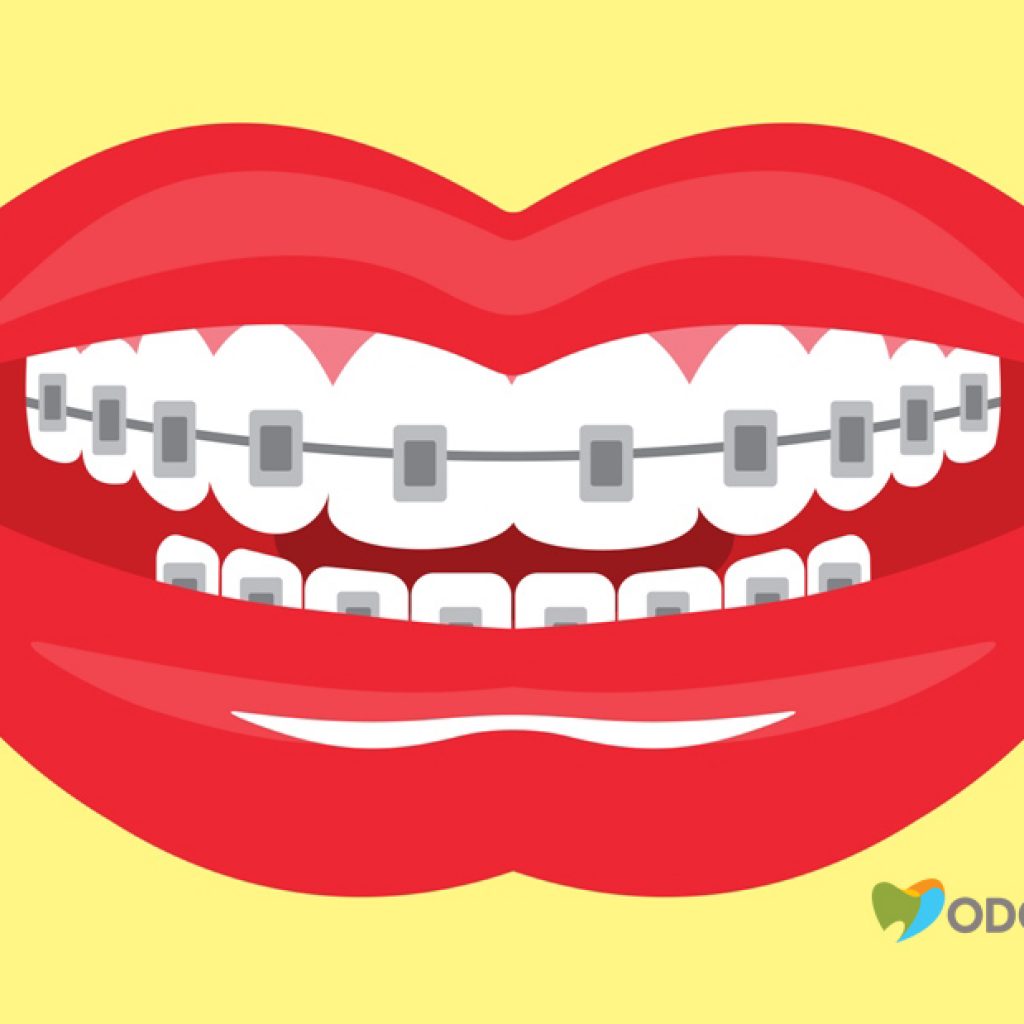 aparelhos-auto-ligados-clinica-odontomania