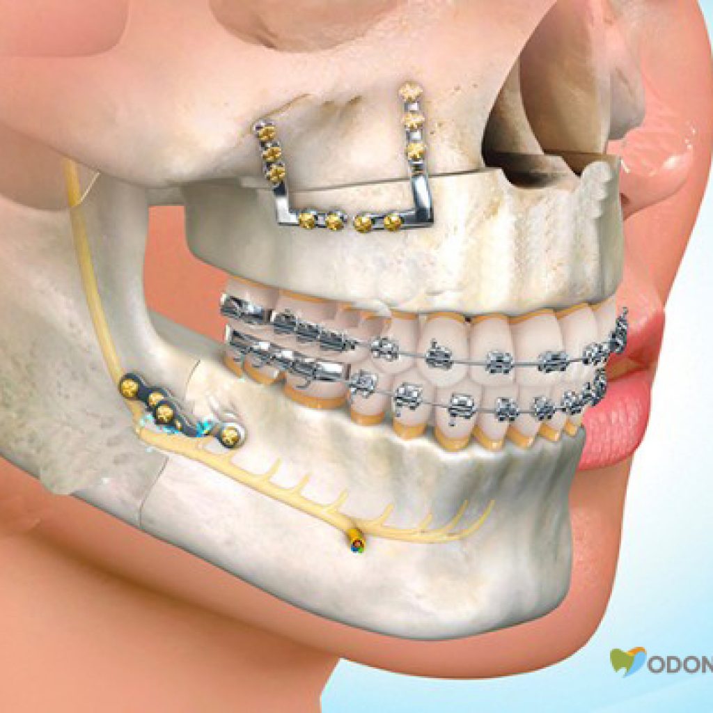 cirurgia-ortognatica-clinica-odontomania