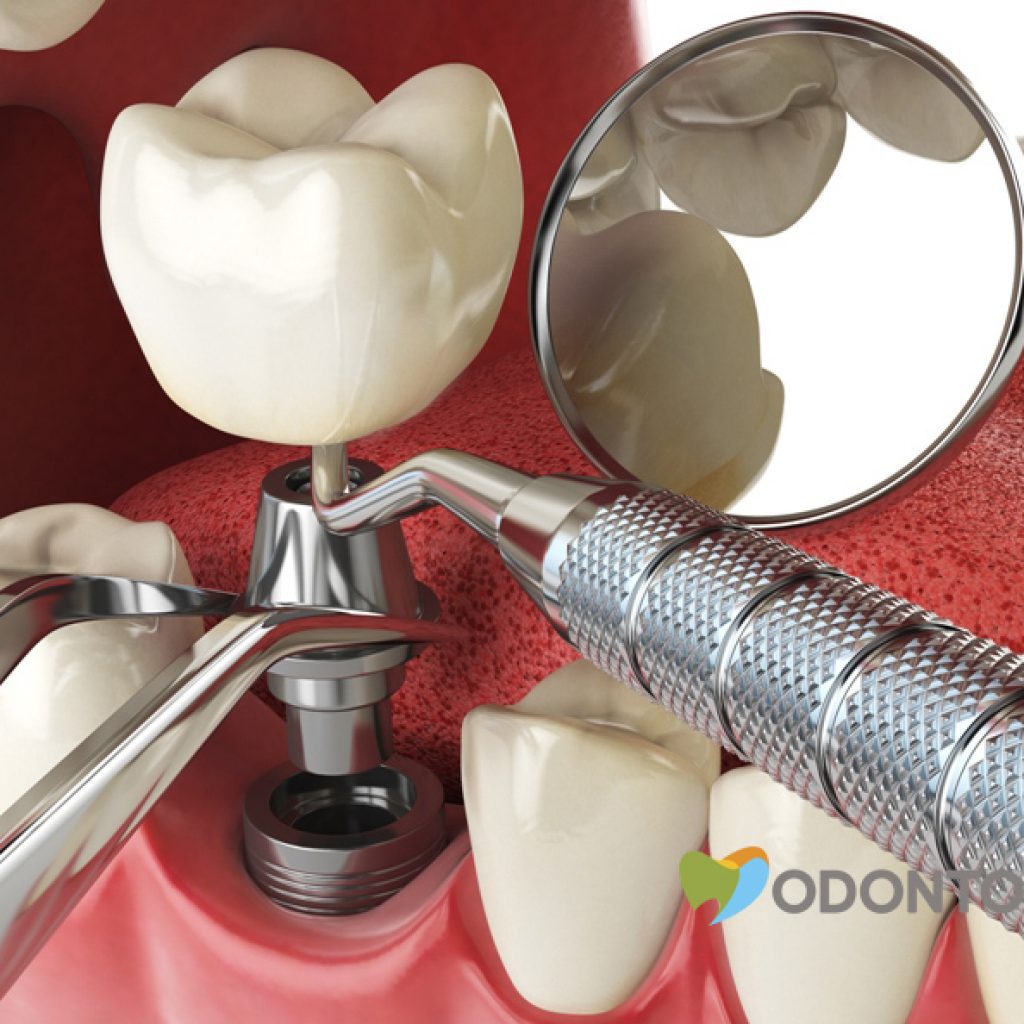 Tcomo-fazer-seu-implante-dentário-dar-certo