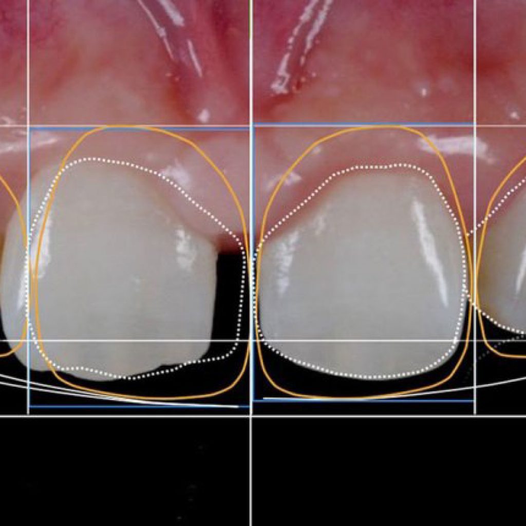 mock-up-simule-seu-sorriso-clinica-odontomania