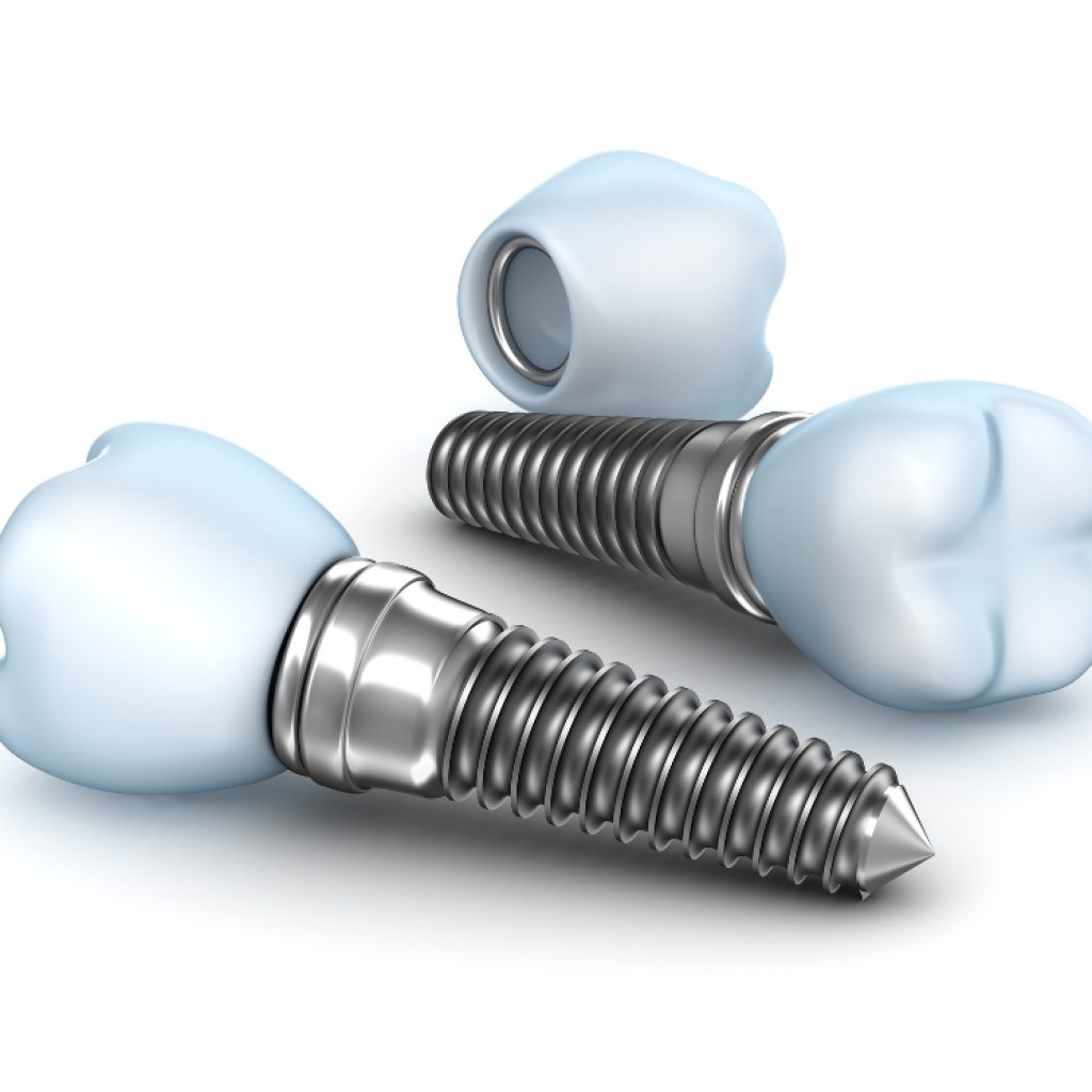 implantes-dentarios-clinica-odontomainia-limao-sao-paulo