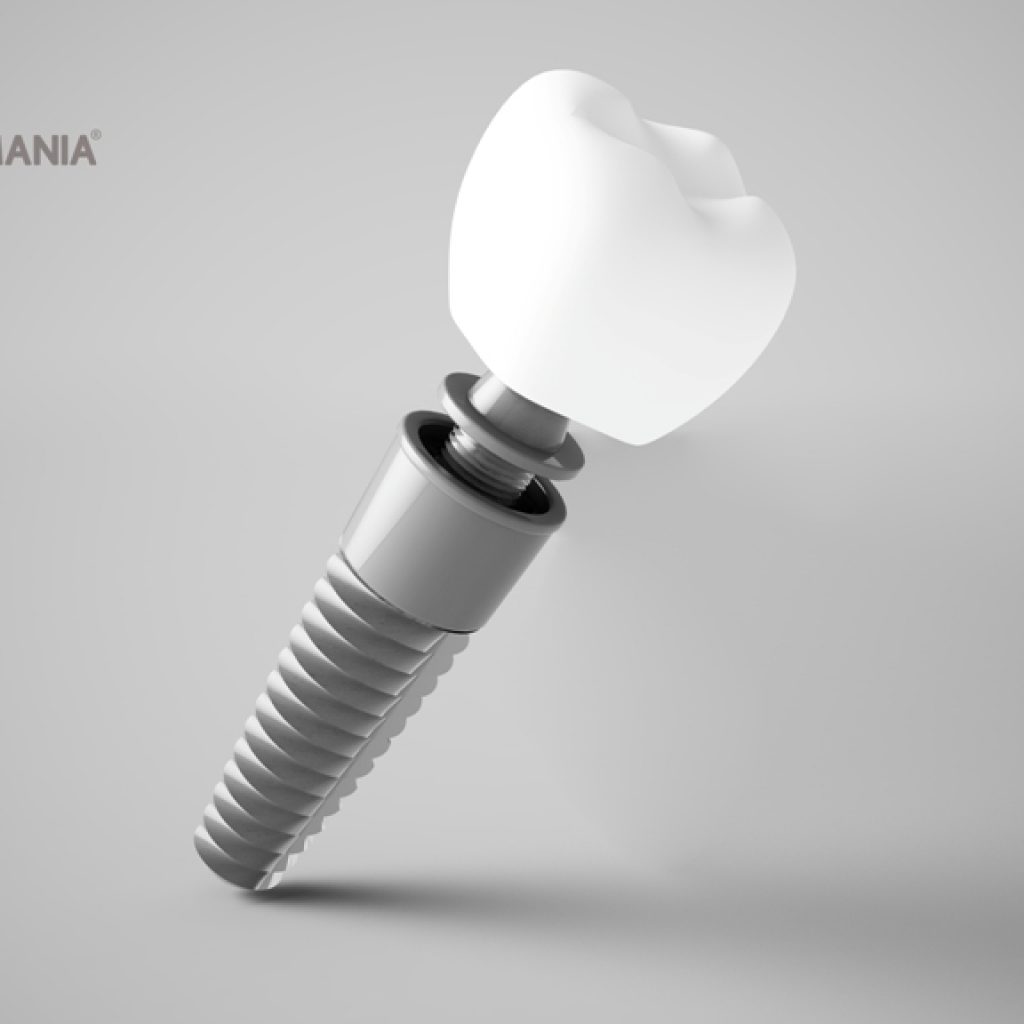 implante-dental-clinica-odontomania